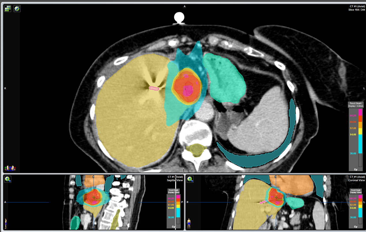 Que es metastasis hepatica